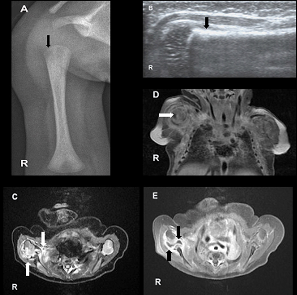 Image course of a 15-day old term newborn with a swollen and
painful right shoulder.A) Radiography of the anteroposterior projection: oedema of the soft
tissue of the shoulder and steolytic defects in the metaphysis humerus (arrow).
Not ossified epiphysis.B) Ultrasound with a small oedema around the humerus neck (arrow) and
tissue edema. C) MR STIR of the right shoulder in the transverse plane: pronounced
oedema of the soft tissue at the shoulder joint (white arrow) and modified bone
signal (black arrow). D) and E) MRI of the right shoulder T1 TSE FS with contrast media
sequence in the coronal and transverse plane: contrast stained soft tissues of
the shoulder joint, thickened and hyperemic synovium and effusion (white
arrows).