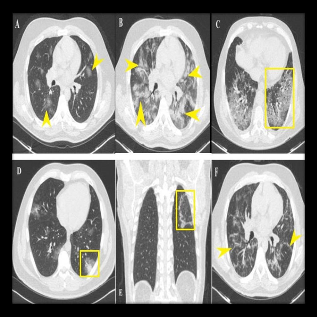 Various lesions of included patients. Yellow arrowheads and boxes
indicated the lesions. A: multiple patchy ground glass densities; B: large
consolidation areas in the bilateral lung; C: crazy paving pattern; D: halo sign;
E: reversed halo sign; F: fibrous tapes.