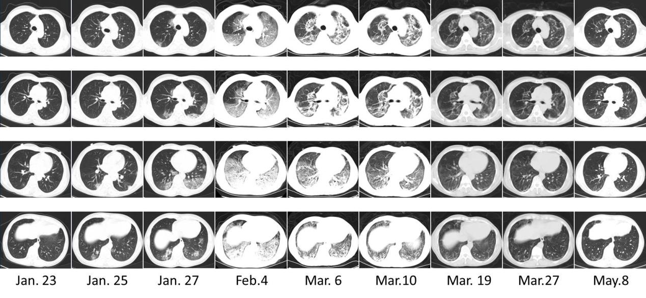 Longitudinal series of transverse chest computed tomography images
during later hospitalization.Images were taken in different course of her
disease and shown in four inconsecutive slices. Single ground-glass opacities
were observed in the outer zone of the right lower lobe on 23 January, which
progressively increased bilaterally into multiple lobes by 27 January. Images on
that day also showed a large, bilateral patch of increased density in the
peripheral region of the lower lobes, with air bronchogram. On 4 February, both
lungs showed large lesions manifesting consolidation and ground-glass opacities.
Images on the two later dates showed substantial absorption of lesions and
replacement by fibrosis, with bronchial traction and dilatation. On 19 and 27
March fibrosis lesions were gradually absorbed and almost disappeared on 5 May.