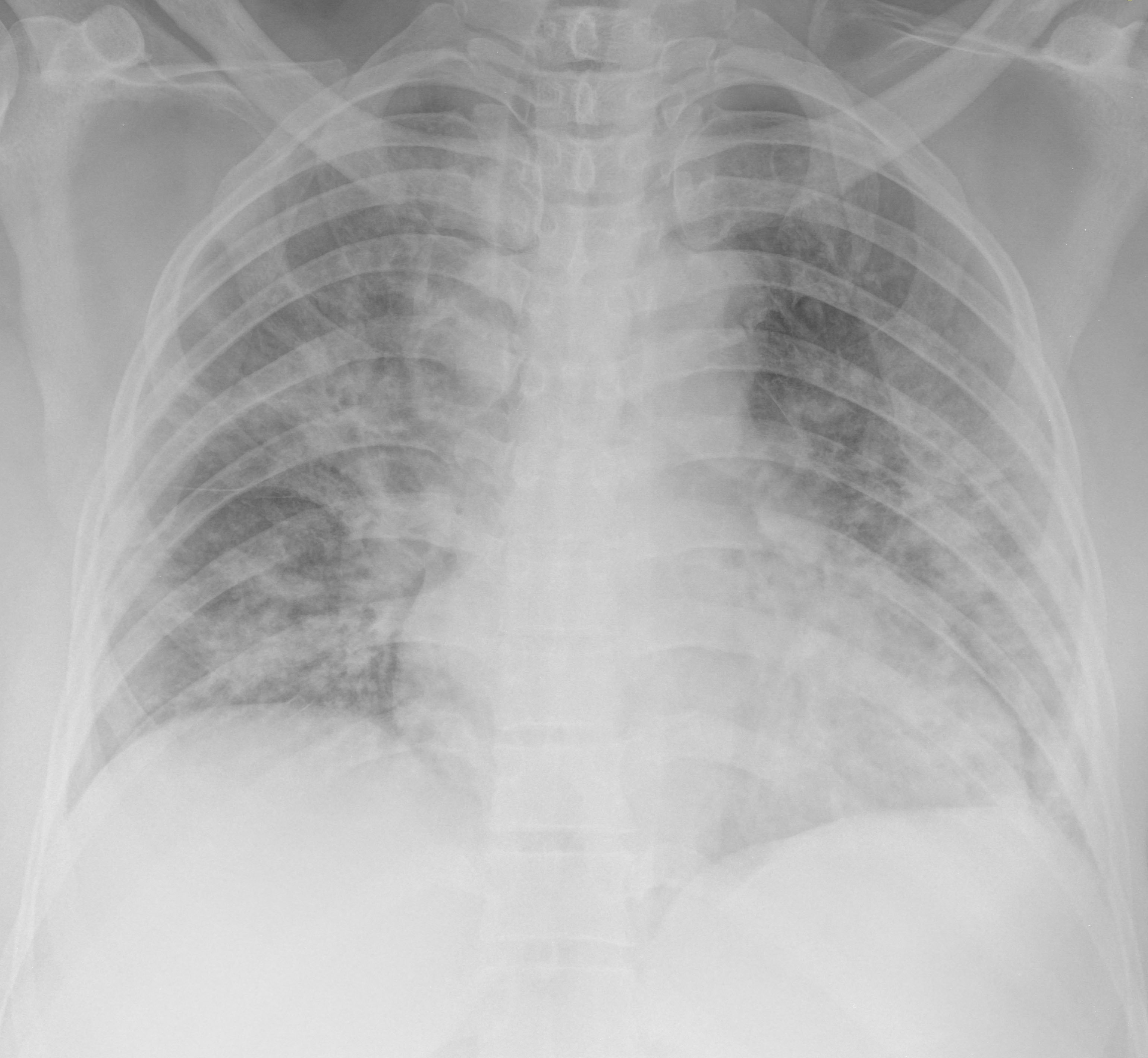 Chest x-ray at emergency department admission.