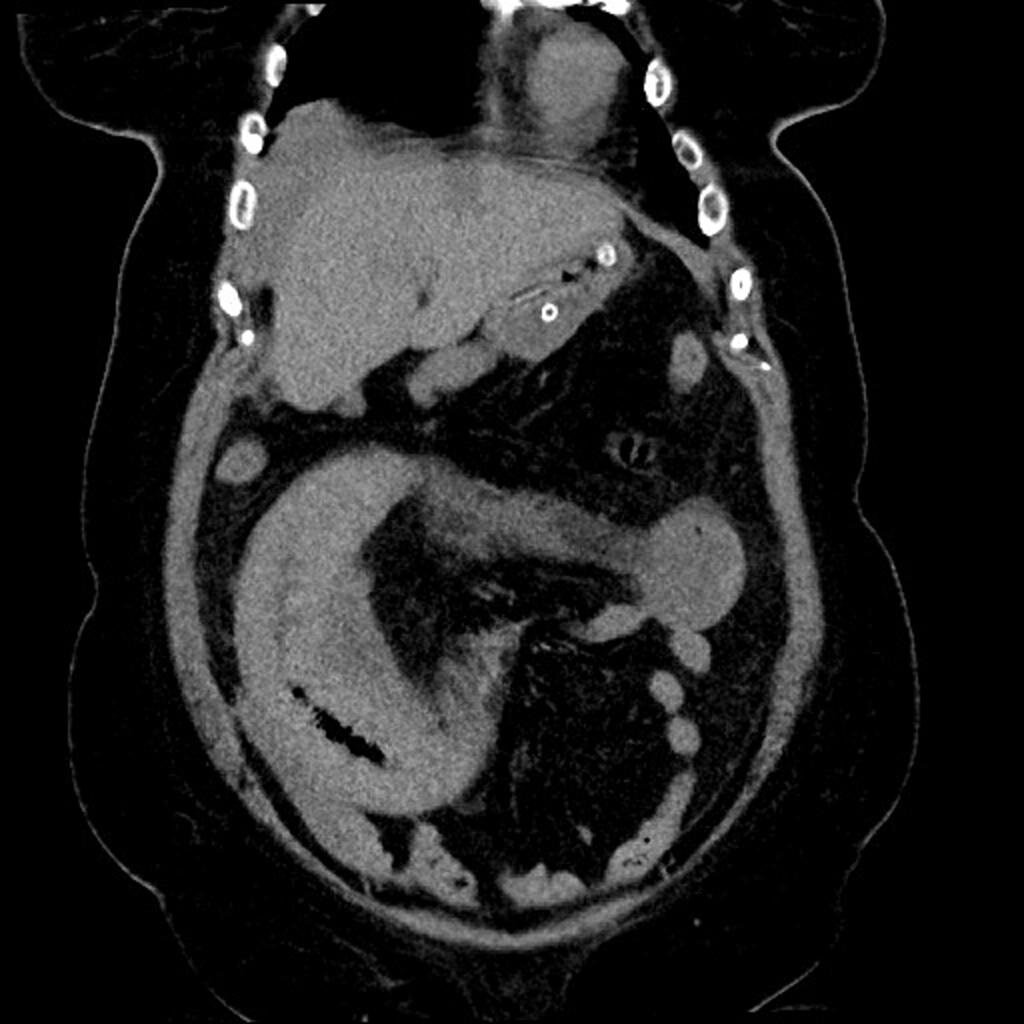 A circumferentially thickened (up to 1.5 cm) hyperdense wall
of an extended proximal section of the jejunum (arrow), which appeared up to 4 cm
in diameter, with accentuated mesentery and blurring of the surrounding fatty
tissue.
