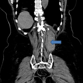 Hematoma of the paravertebral muscles (arrow) on the left side
(length 20 cm, axial width 6 cm).
