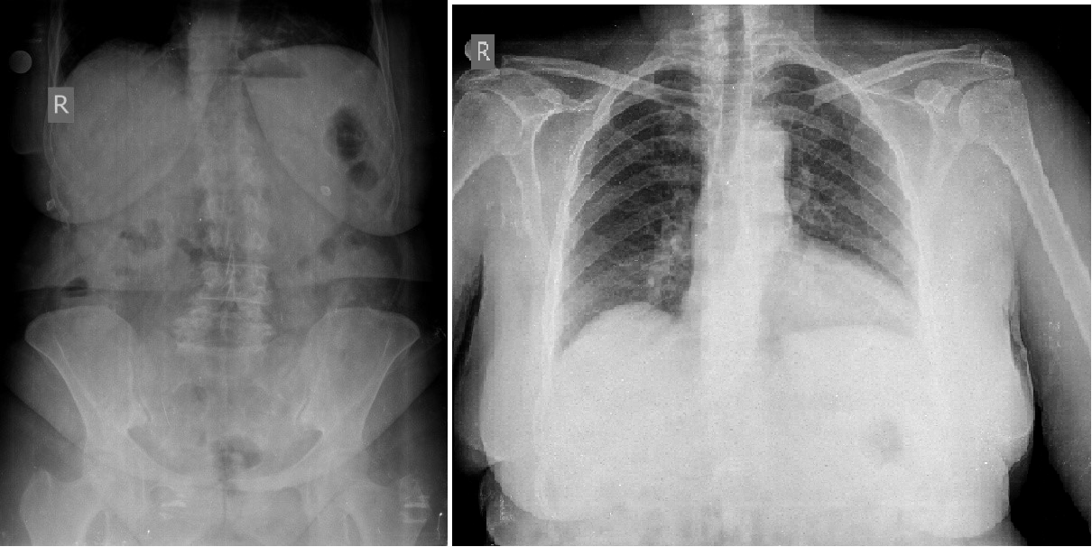 Plain abdominal and AP lung x-ray graphies.