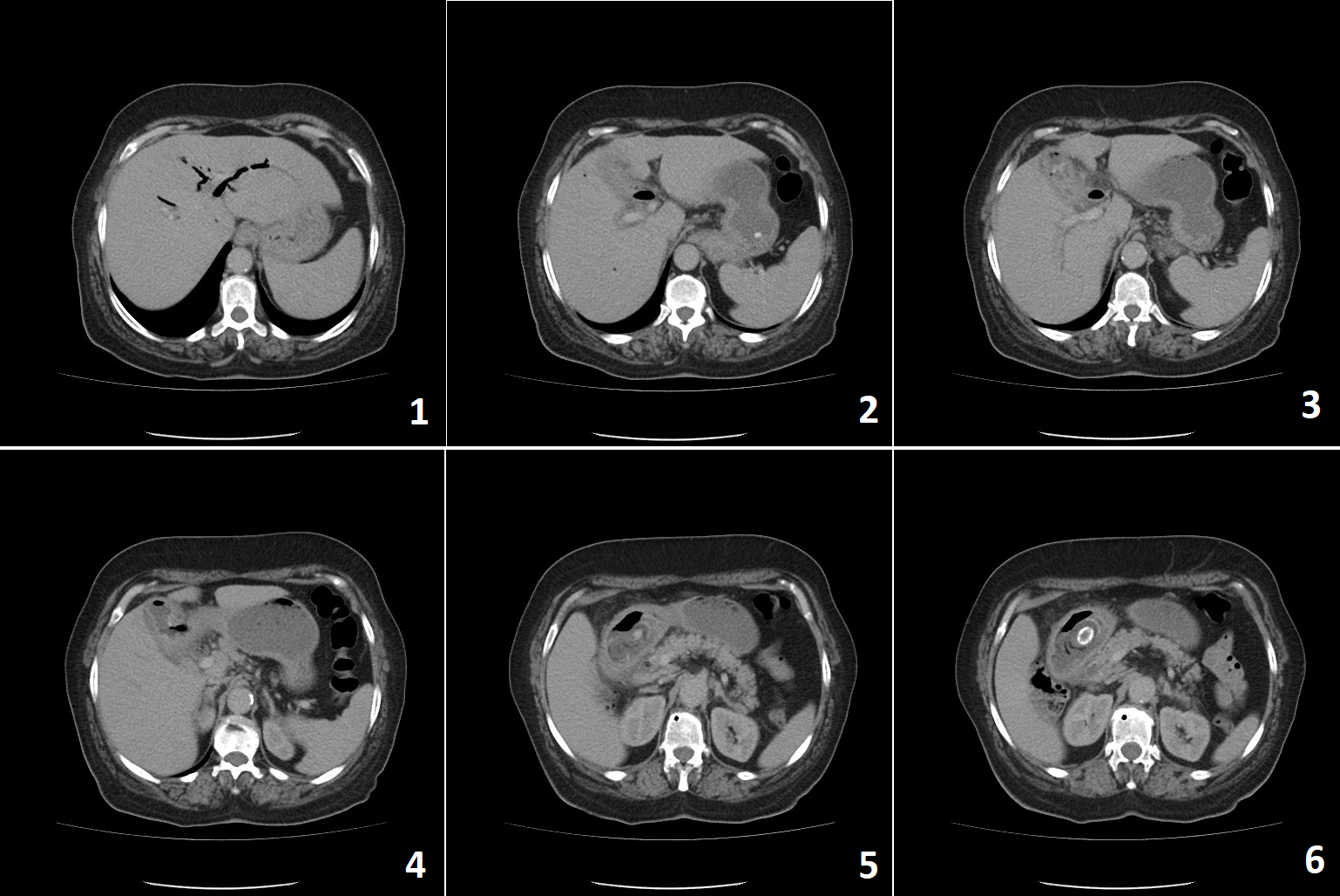 IV contrast-enhanced abdominal computed tomography.