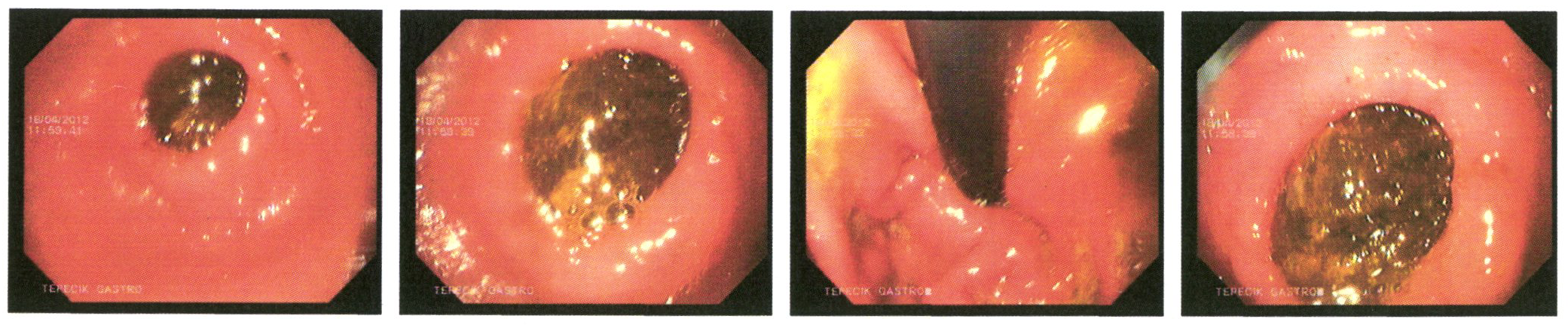 Endoscopic imaging.