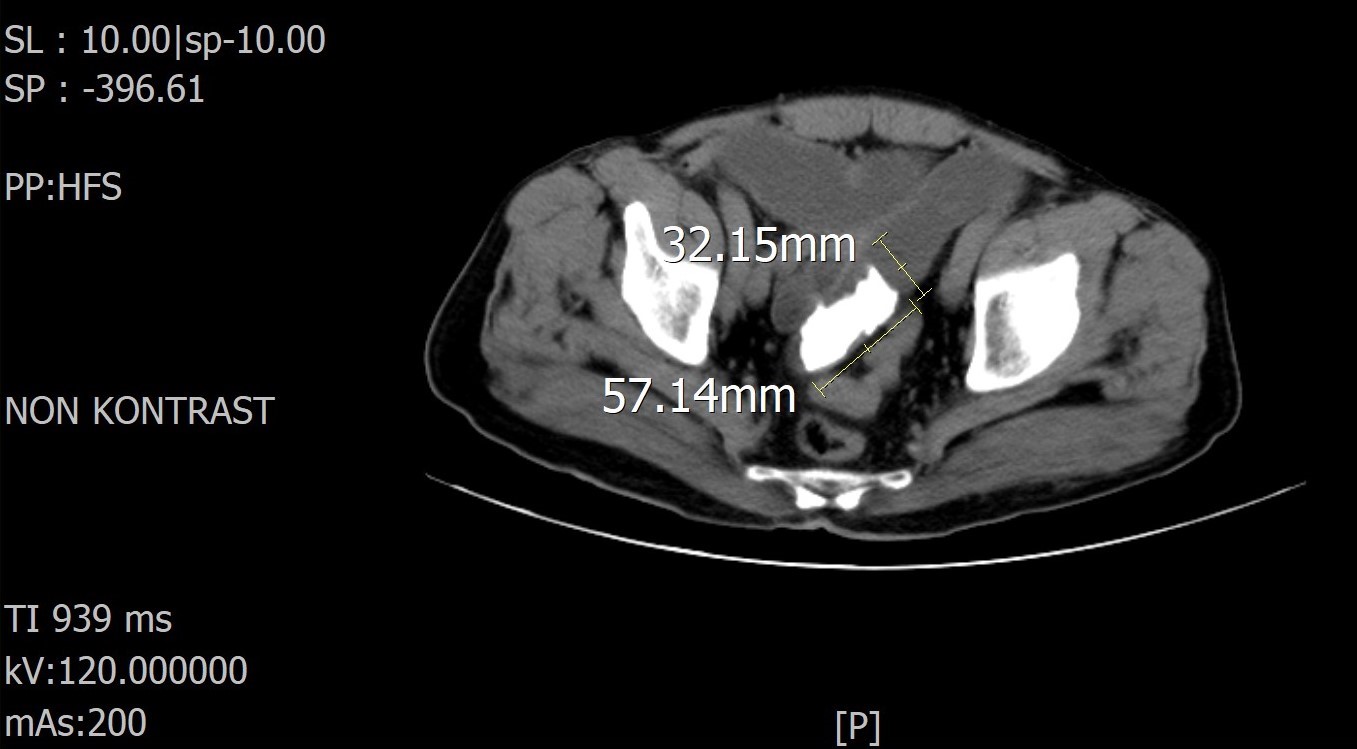 On the abdominal CT, foreign body image in the distal ileus.