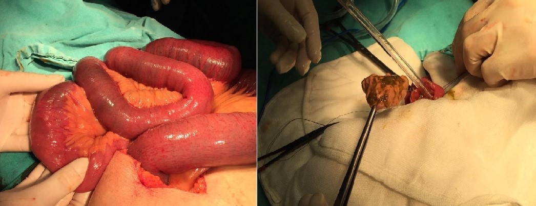 The extracted object in the surgical evaluation and alginate.