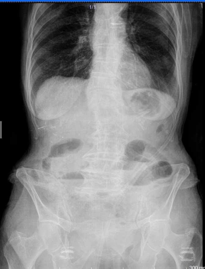 Abdomen X-Ray shows air fluid levels.
