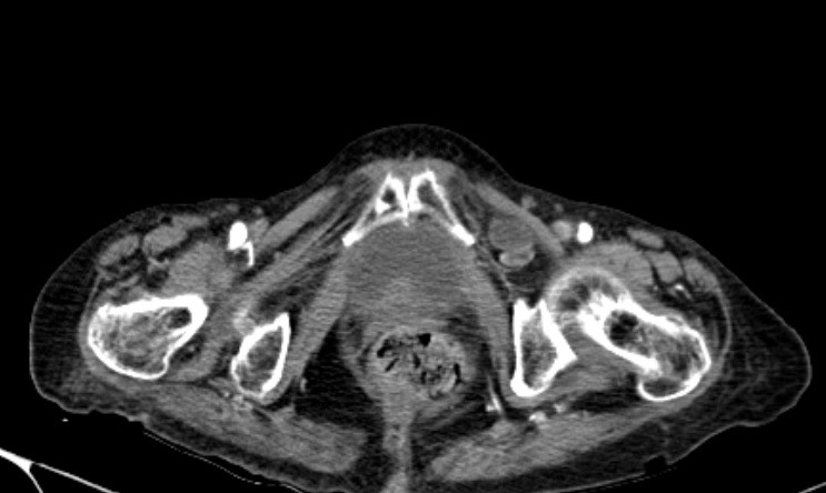 CT shows intestinal loop in the left obturator canal.