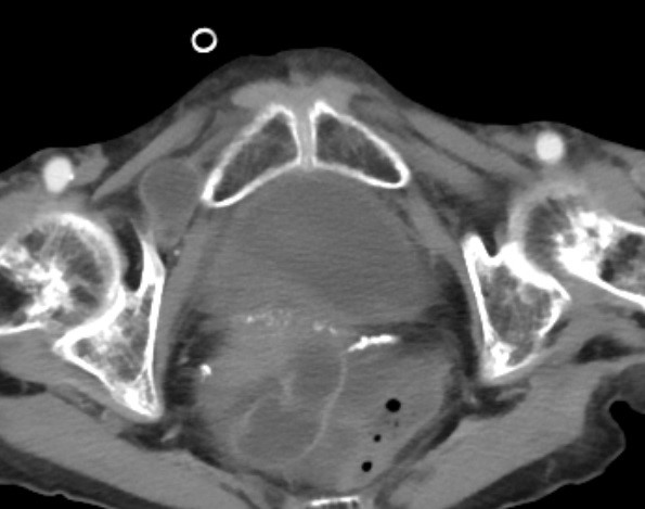 CT shows intestinal loop in the right obturator canal.