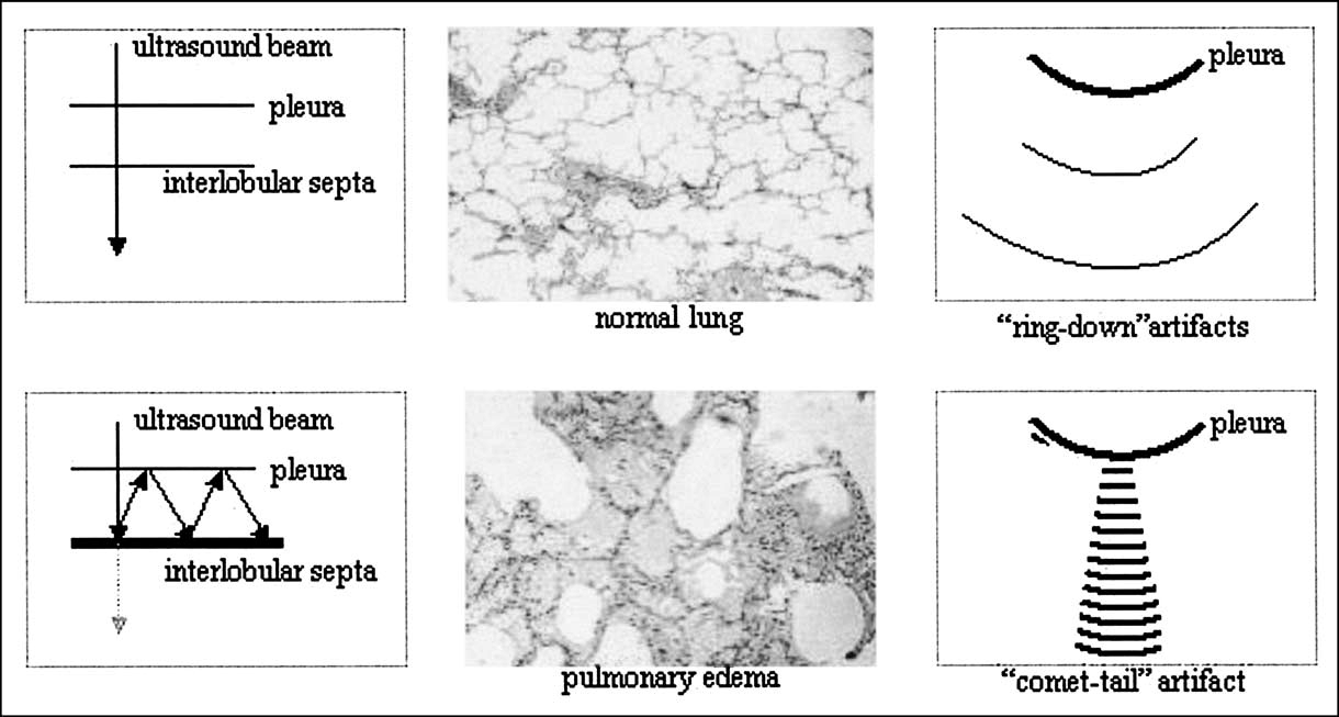 Schematic image of B-line artifact formation by reverberation 
phenomenon.Source: Jambrik Z, Monti S, Coppola V, Agricola E, Mottola G, Miniati M, 
et al. Usefulness of ultrasound lung comets as a nonradiologic sign of 
extravascular lung water. Am J Cardiol. 2004;93(10):1265–70. [8].