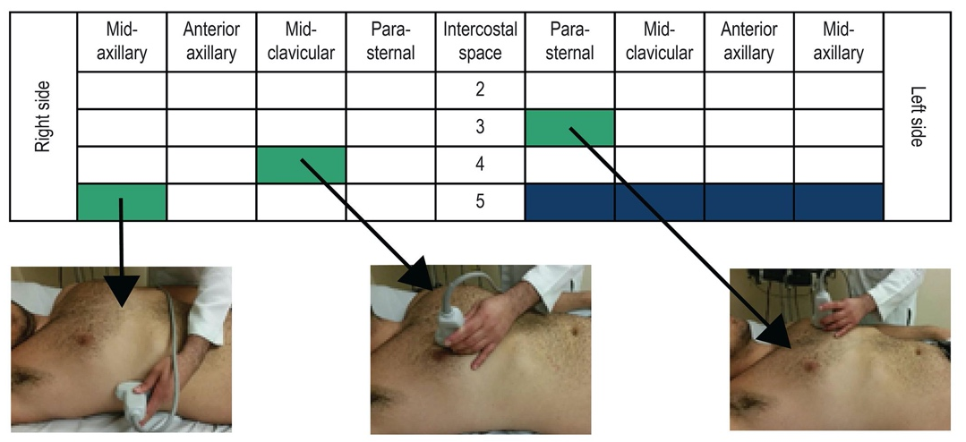 Method of lung scanning via 28 scanning windows.Source: Jambrik Z, Monti S, Coppola V, Agricola E, Mottola G, Miniati M, 
et al. Usefulness of ultrasound lung comets as a nonradiologic sign of 
extravascular lung water. Am J Cardiol. 2004;93(10):1265–70. [8].
