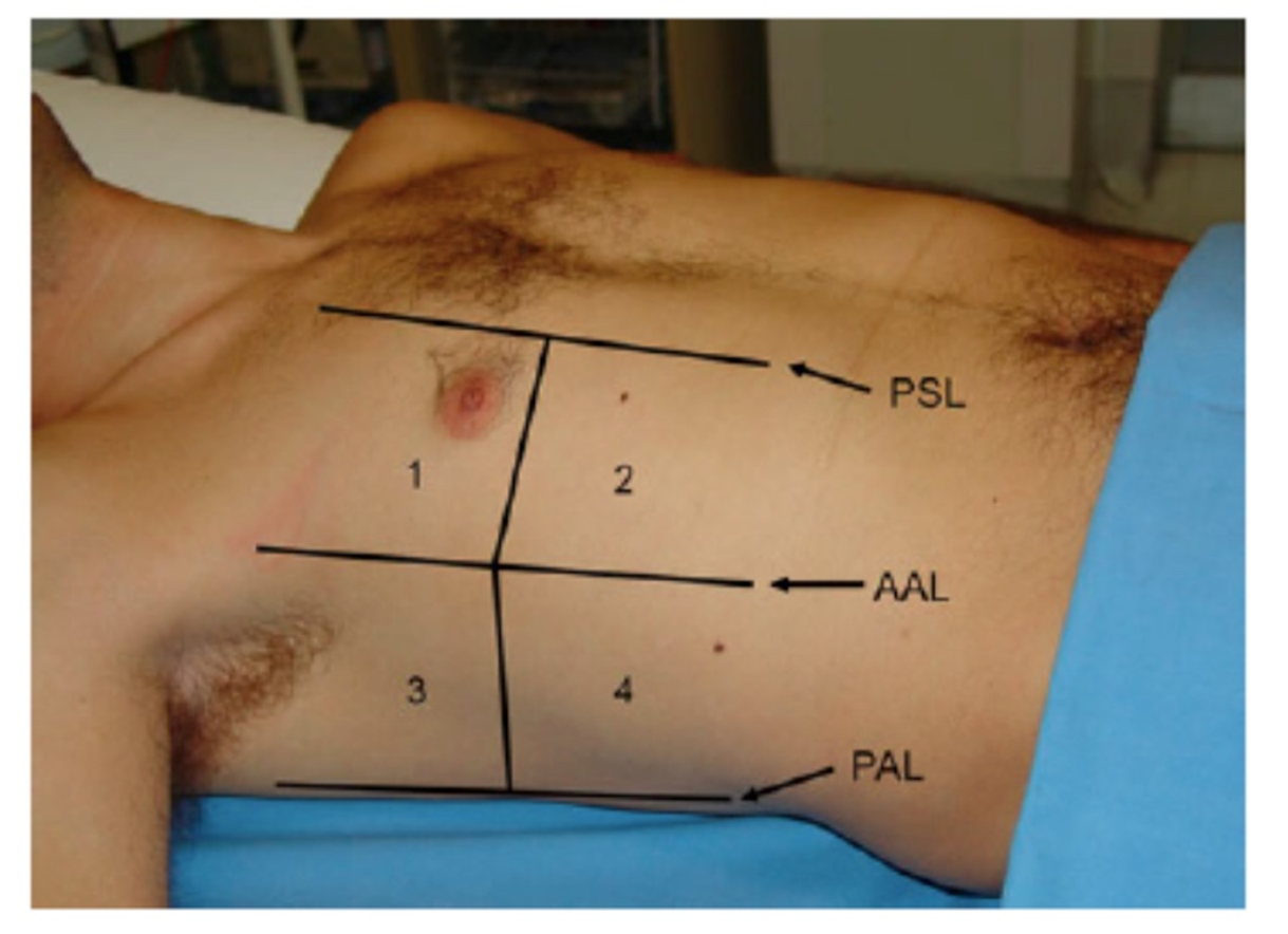 Volpicelli’s 4-quadrant approach.Source: Volpicelli G, Mussa A, Garofalo G, Cardinale L, Casoli G, 
Perotto F, et al. Bedside lung ultrasound in the assessment of 
alveolar-interstitial syndrome. Am J Emerg Med. 2006;24(6):689–96. [6].