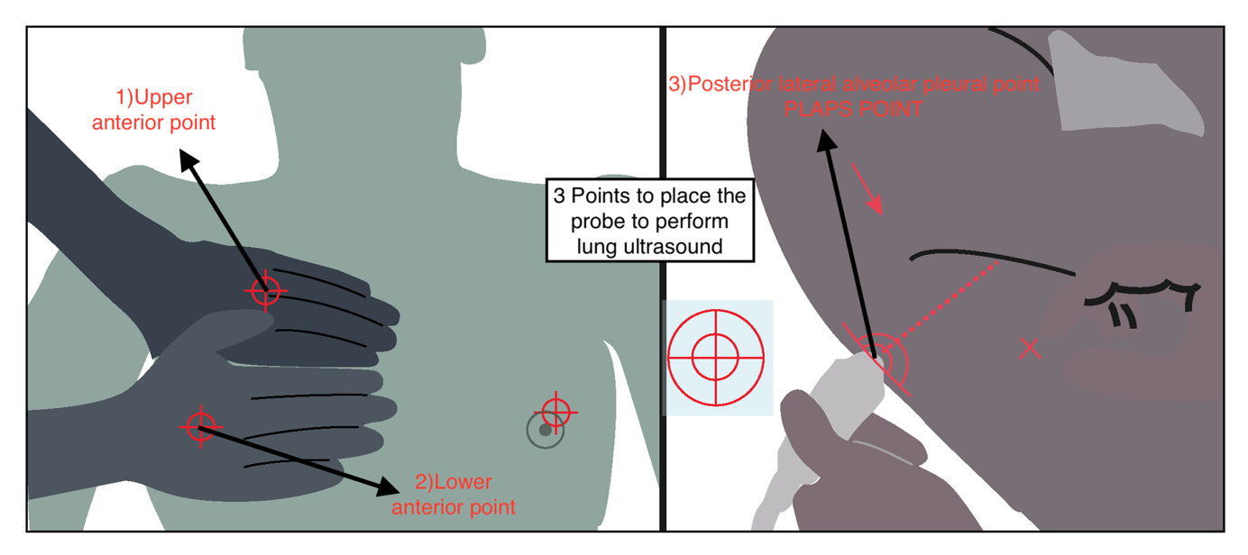 BLUE protocol scanning points.Source: Raheja R, Brahmavar M, Joshi D, Raman D. Application of Lung 
Ultrasound in Critical Care Setting: a Review. Cureus. 2019;11(7):e5233. [11].