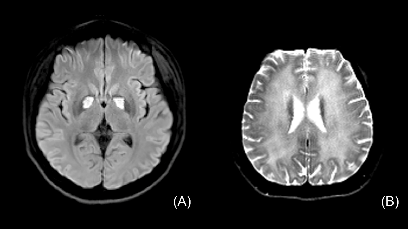 Brain magnetic resonance imaging for case 1. (A) diffusion-weighted imaging revealed a central high-signal intensity
lesion surrounded by a low-signal-intensity ring in the globus pallidus
(Eye-of-the-tiger sign) in acute carbon monoxide poisoning; (B) T2 imaging
revealed extensive bilateral symmetrical confluent high-intensity cerebral white
lesions after the onset of delayed neurological sequelae.