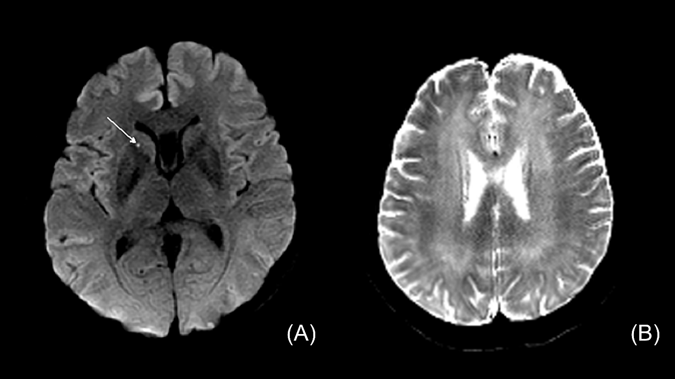 Brain magnetic resonance imaging for case 2.(A) diffusion-weighted imaging revealed scattered, tiny high signal
intensities in the right caudate nucleus in acute carbon monoxide poisoning; (B)
T2 imaging revealed apparent confluent high signal intensity in the bilateral
subcortical white matter after the onset of delayed neurological sequelae.