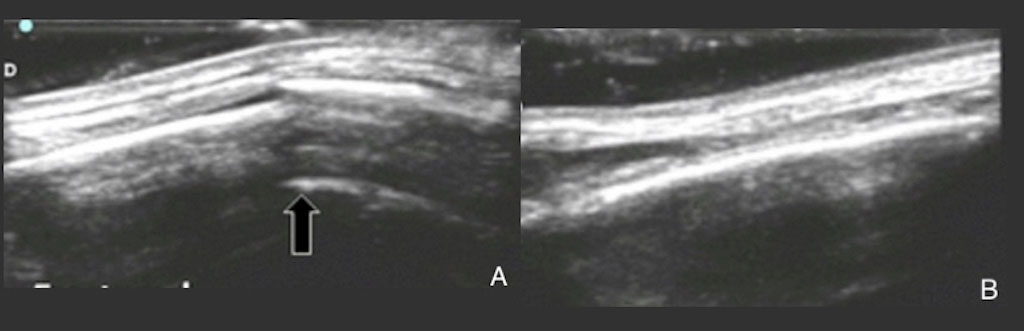 Ultrasound images of fractured (A) and normal (B) clavicle. Arrow point to region of cortical interruption on US.