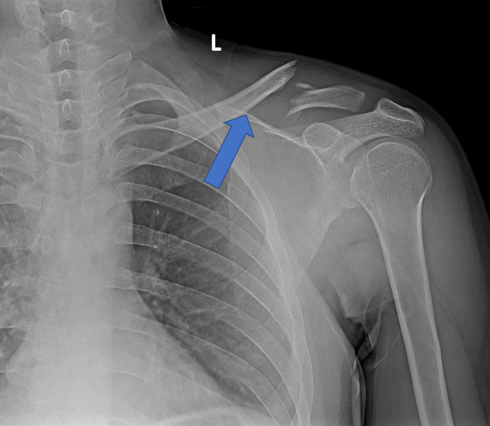 Left mid-clavicular fracture on plain radiography.
