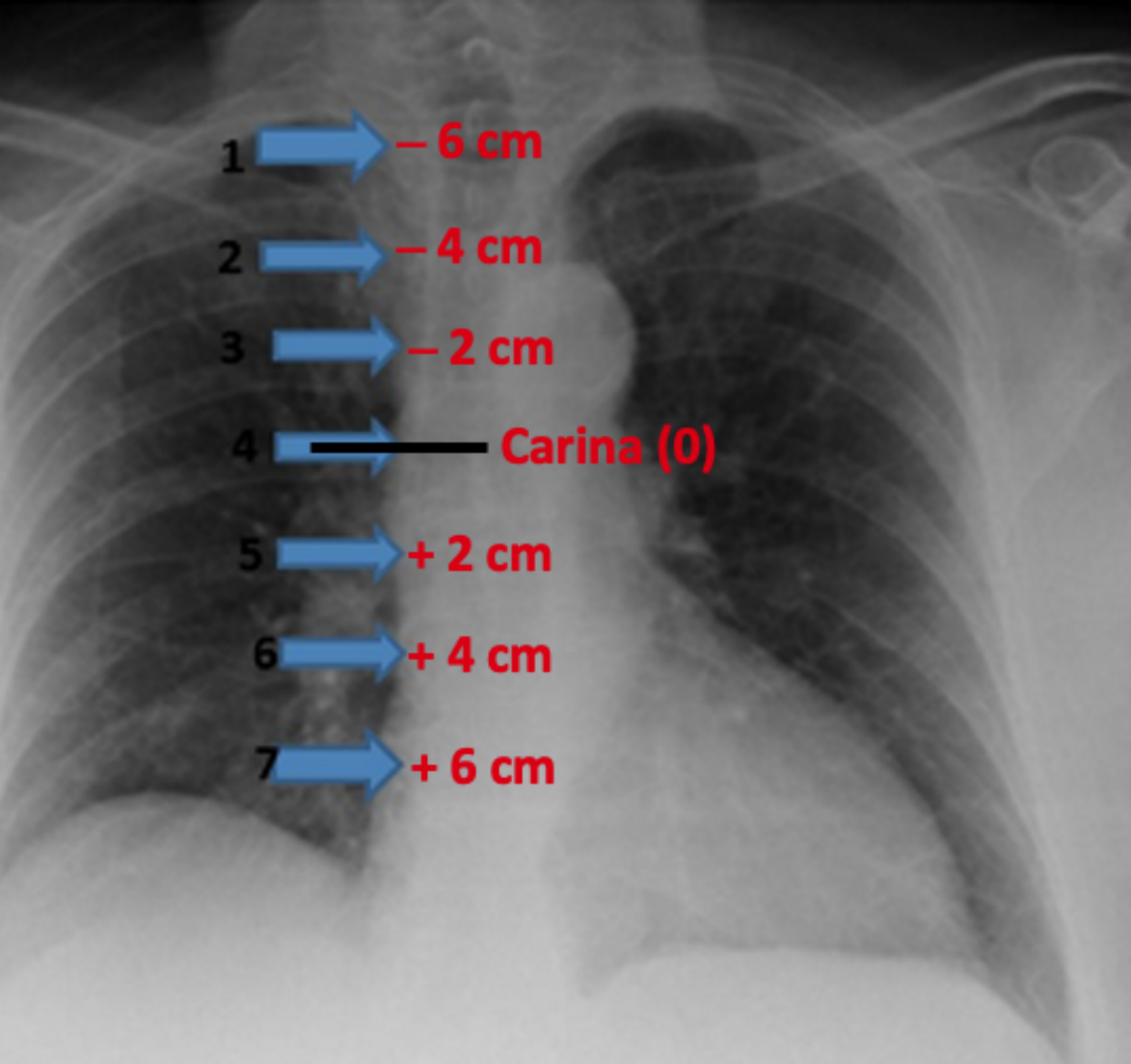 Chest radiograph with multiple levels to facilitate
selection of the optimal upper and lower acceptable levels based on the distance
from the carina.