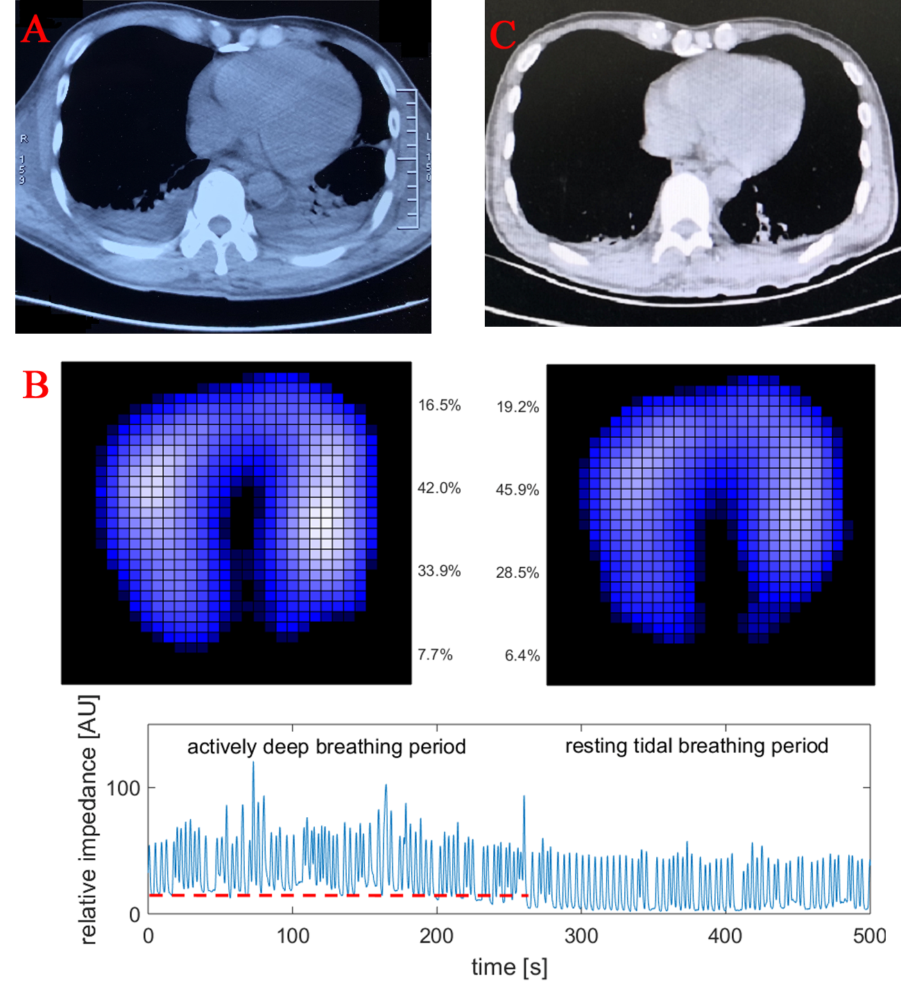 CT and EIT measurements of the patient.(A) Chest CT before admission indicated atelectasis and pleural effusion at the lower lobes of both lungs. (B) EIT images showing tidal variation during actively deep breathing (left) and resting tidal breathing (right) period. Light blue depicted regions with high ventilation. Percentage indicated ventilation distribution in ventral and dorsal regions along the gravity axis. Actively deep breathing improved end-expiratory lung volume (bottom figure, red dashed line). (C) CT image after weaning demonstrated significant improvement of atelectasis and pleural effusion.