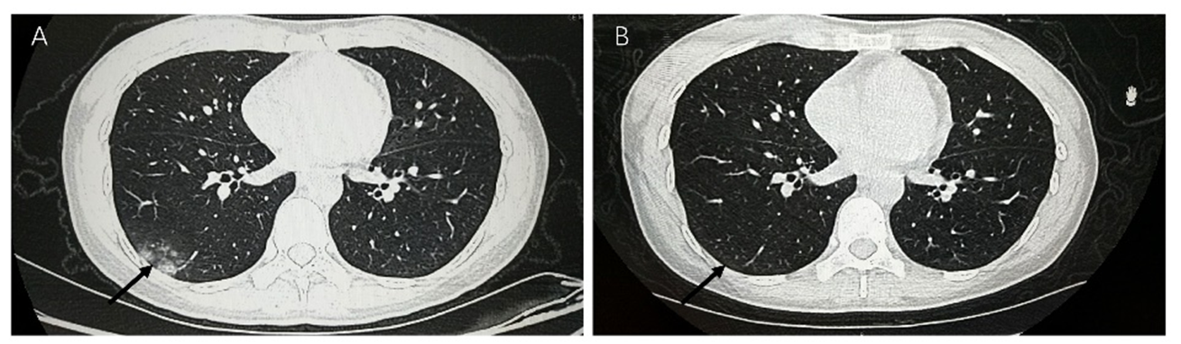 Comparison of lung CT scans.Lung CT scan on January 19 (illness day 3). (B) Lung CT scan on January 31 (illness day 15).