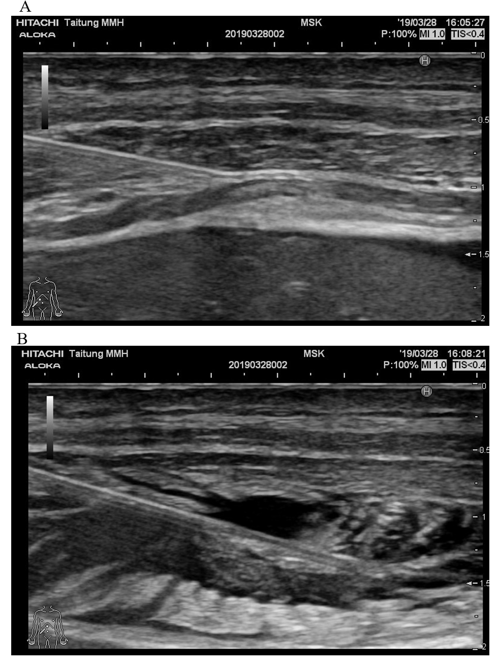Sono-guide subcostal transversus abdominis plane block with 20 ml of
Bupivacaine 0.25%.