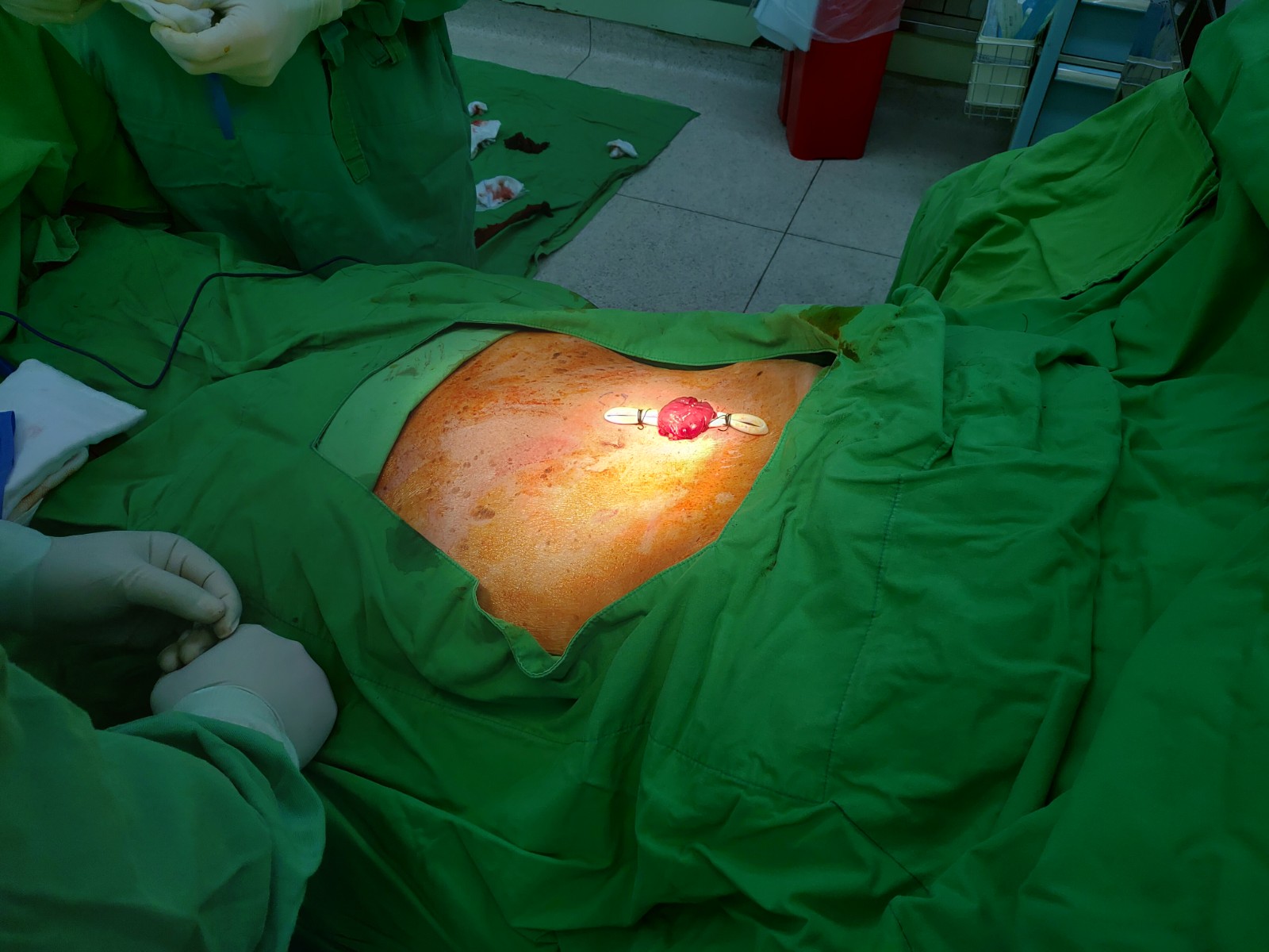 Colostomy in right upper quadrate abdomen.