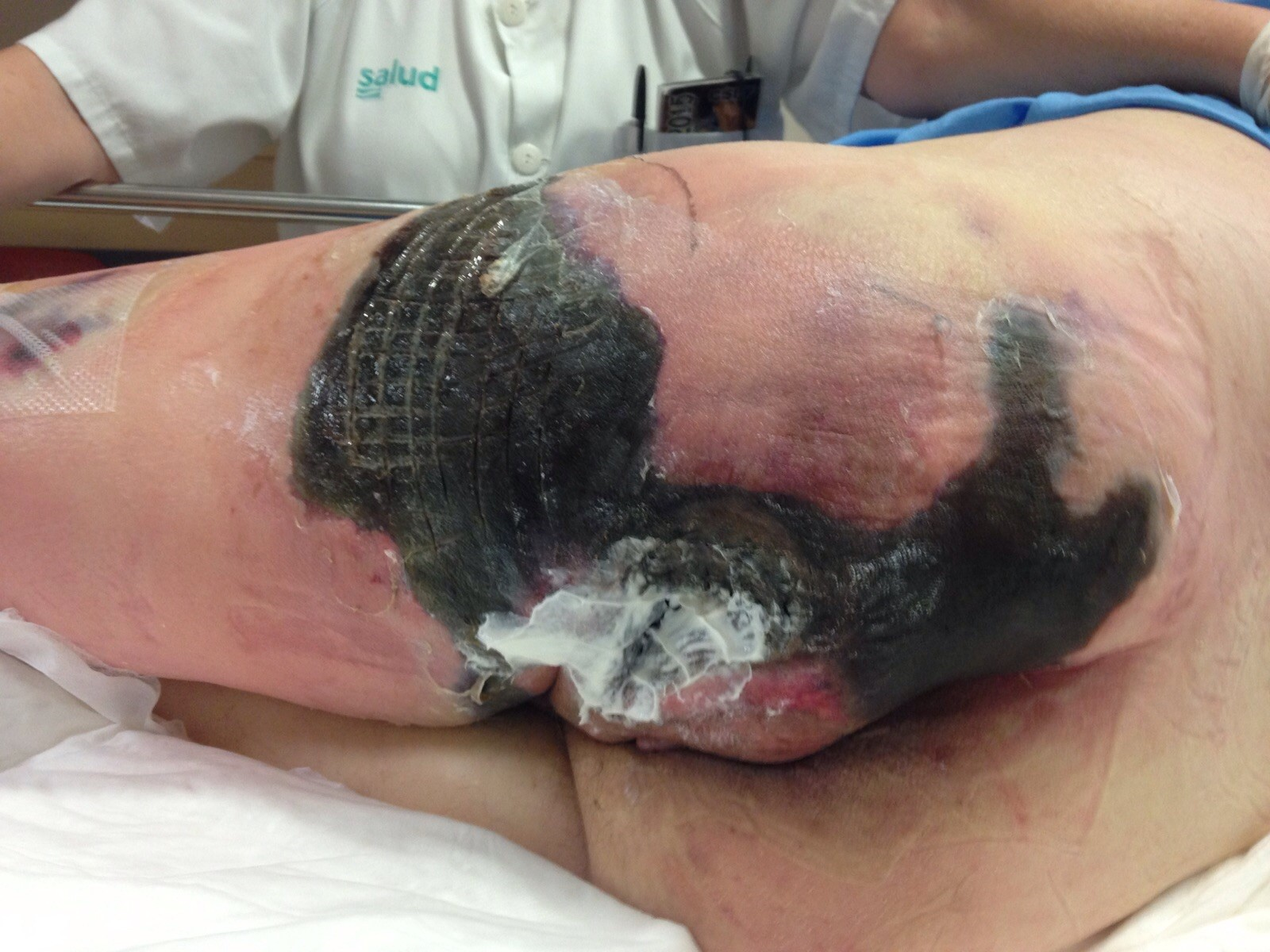 Decubitus Pressure Ulcer.