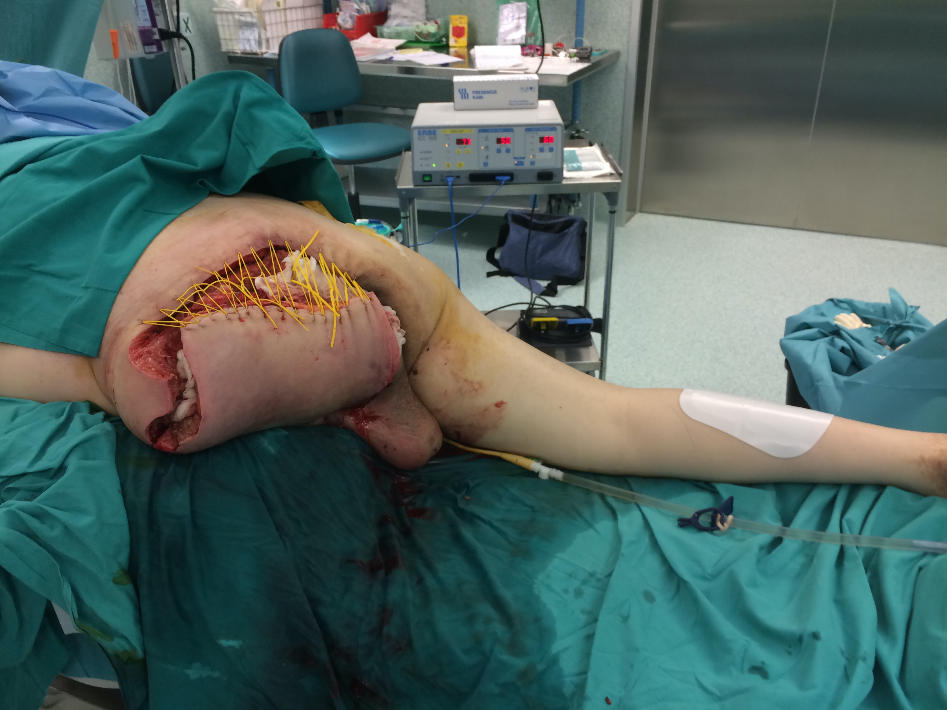 Amputation and Disarticulation of Left Coxofemoral Joint and
Musculocutaneous Reconstruction.