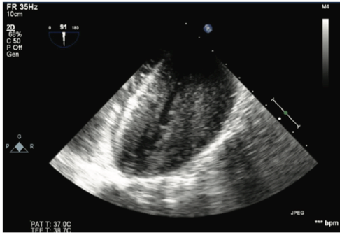 Emergency TEE image of left ventricle during resuscitation
demonstrating almost complete cavity obliteration and severe LVH throughout the
ventricle.