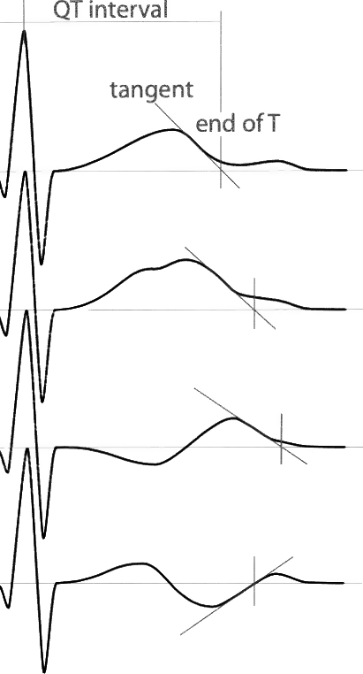 Schematic illustration of the tangent method to define the end 
of different T-wave forms. Adapted figure reproduced from Postema et al. with 
permission [16].