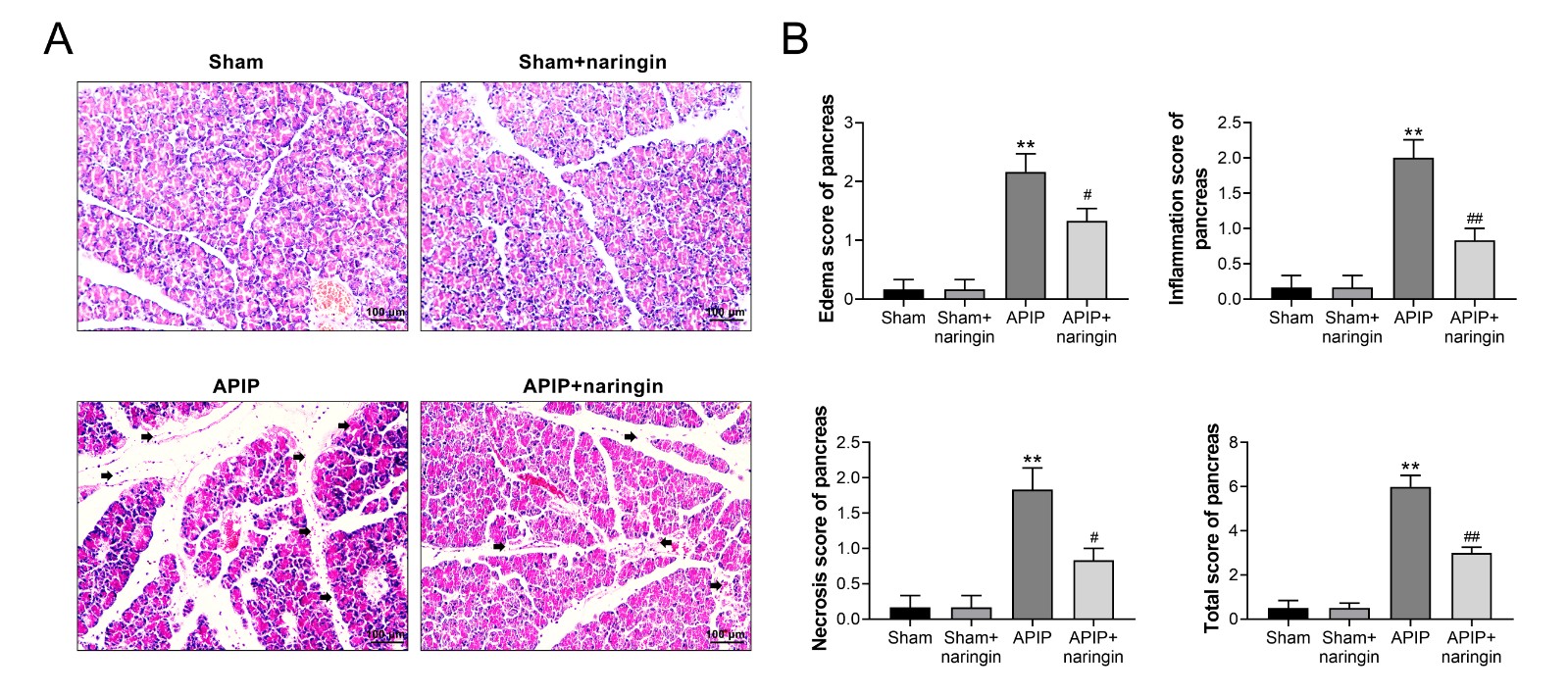 Amelioration of histopathologic injury in pancreas by
naringin.(A) Representative pathological changes in pancreas detected by H&E
staining in magnification of ×200. Scale bars: 100 μm.
(B) Histological scores of pancreatic tissue, including edema, necrosis,
inflammation and total score of pancreas. (n = 6).
** p < 0.01 vs. sham group,
#, ## p < 0.05, p < 0.01 vs. APIP group.