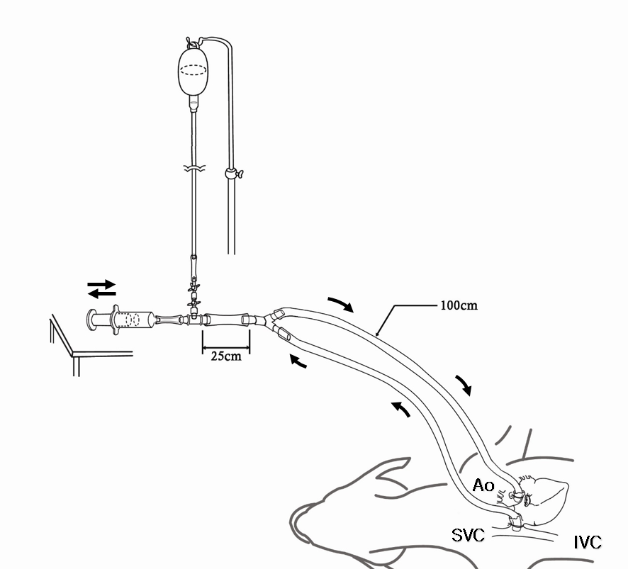 A diagram for an extracorporeal circulation. A Y-shaped
extracorporeal circuit was composed of tubes, connectors containing a side hole
(for dye injection), and a 50 cc enema syringe. Two 3/8″ by 1 m PVC tubes
bearing two 3/8″ straight connectors were inserted into their distal ends, and
their proximal ends were connected to the two equivalent arms of a 3/8″ Y
connector. The other end of the Y connector was connected to a 3/8” by 25 cm
long PVC tube and the free end of this tube was fitted with 3/8″- 1/4″ adapter
to allow a 1/4″ by 5 cm PVC tube containing the syringe to be fitted. One of the
1 m long tubes was then introduced via the right atrium to the junction of the
vena cava and the right atrium. The aorta was transected above the aortic valve
and the 3/8″ connector of the other 1 m long tube was introduced directly into
the aorta. Extracorporeal circulation was initiated with pull/push movements of
the syringe, positioned at the midline level of the heart, after declamping the
circuits. SVC, superior vena cava; IVC, inferior vena cava; Ao, aorta.