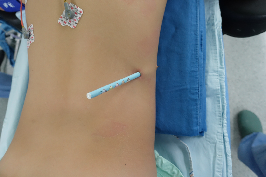 A-10-year old girl with a pencil stab wound in the back.