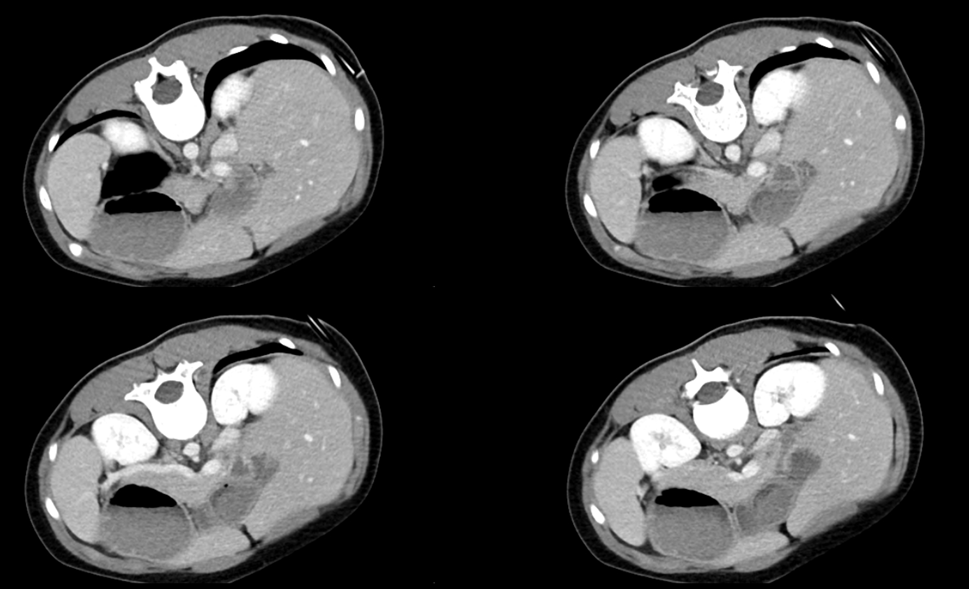 CT scans showing the location of the pencil.