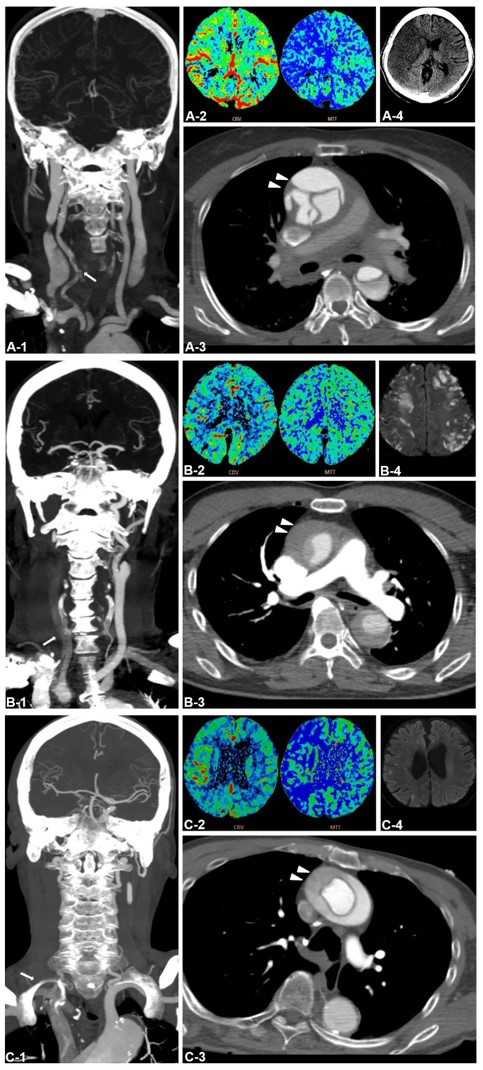 Brain perfusion computed tomography angiography and magnetic
resonance imaging findings.(A-C) Brain perfusion computed tomography
angiography (p-CTA) shows severe stenosis or occlusion of the right common
carotid artery (arrow) (A-1, B-1, C-1). Severe cerebral perfusion mismatch is
seen in the right hemisphere (A-2, B-2, C-2). Axial enhanced p-CTA shows aortic
dissection involving the right wall of the ascending aorta (arrowhead) (A-3, B-3,
C-3). Extensive right hemispheric cerebral infarction (A-4) and multifocal
infarctions in the bilateral cerebral hemispheres (B-4) are observed after
surgery for aortic dissection without stenting. After emergency stenting followed
by surgery, only a small focal cerebral infarction is observed in (C-4).