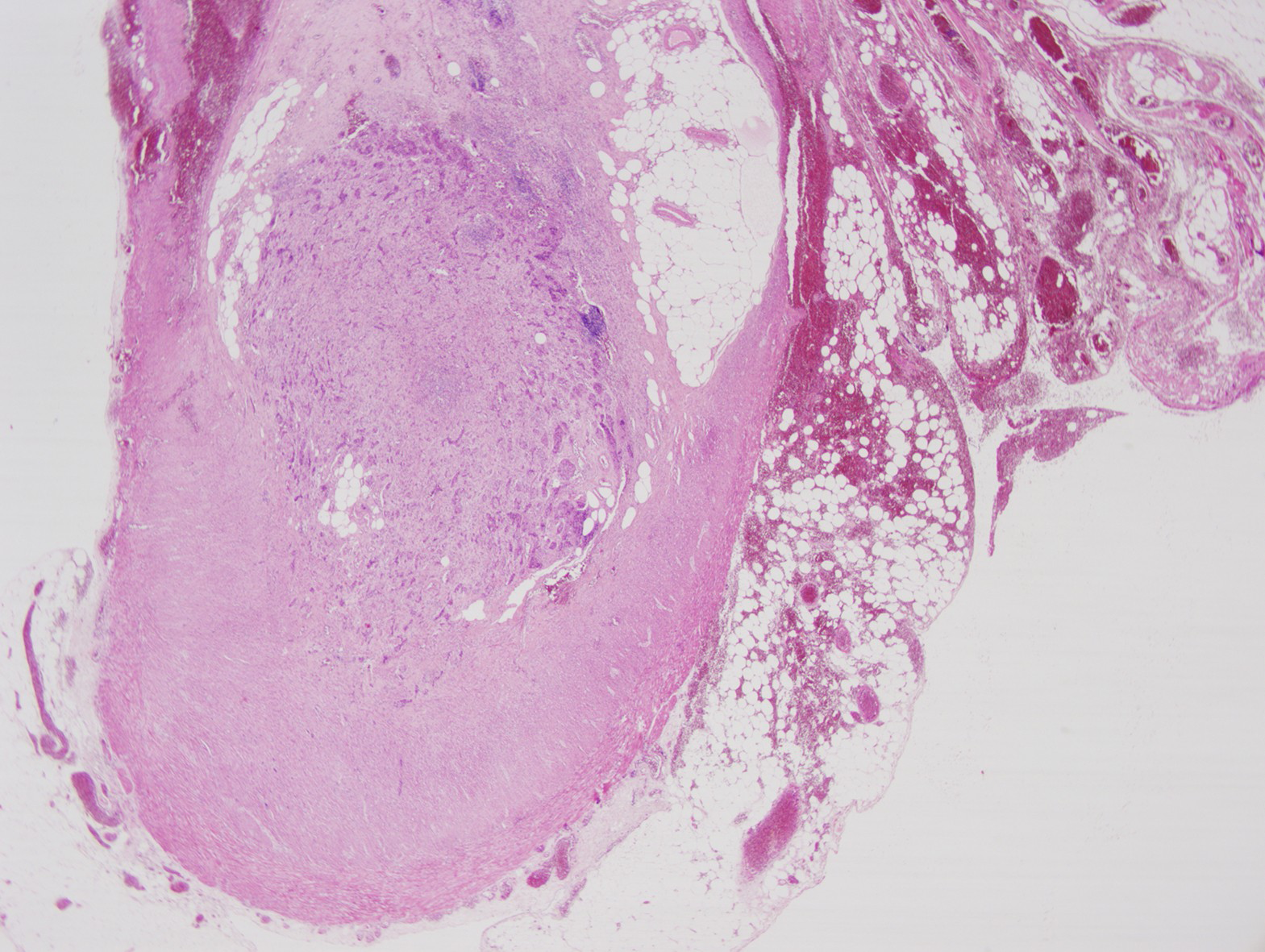 X20, hematoxylin-eosin staining, neuroendocrine tumor.