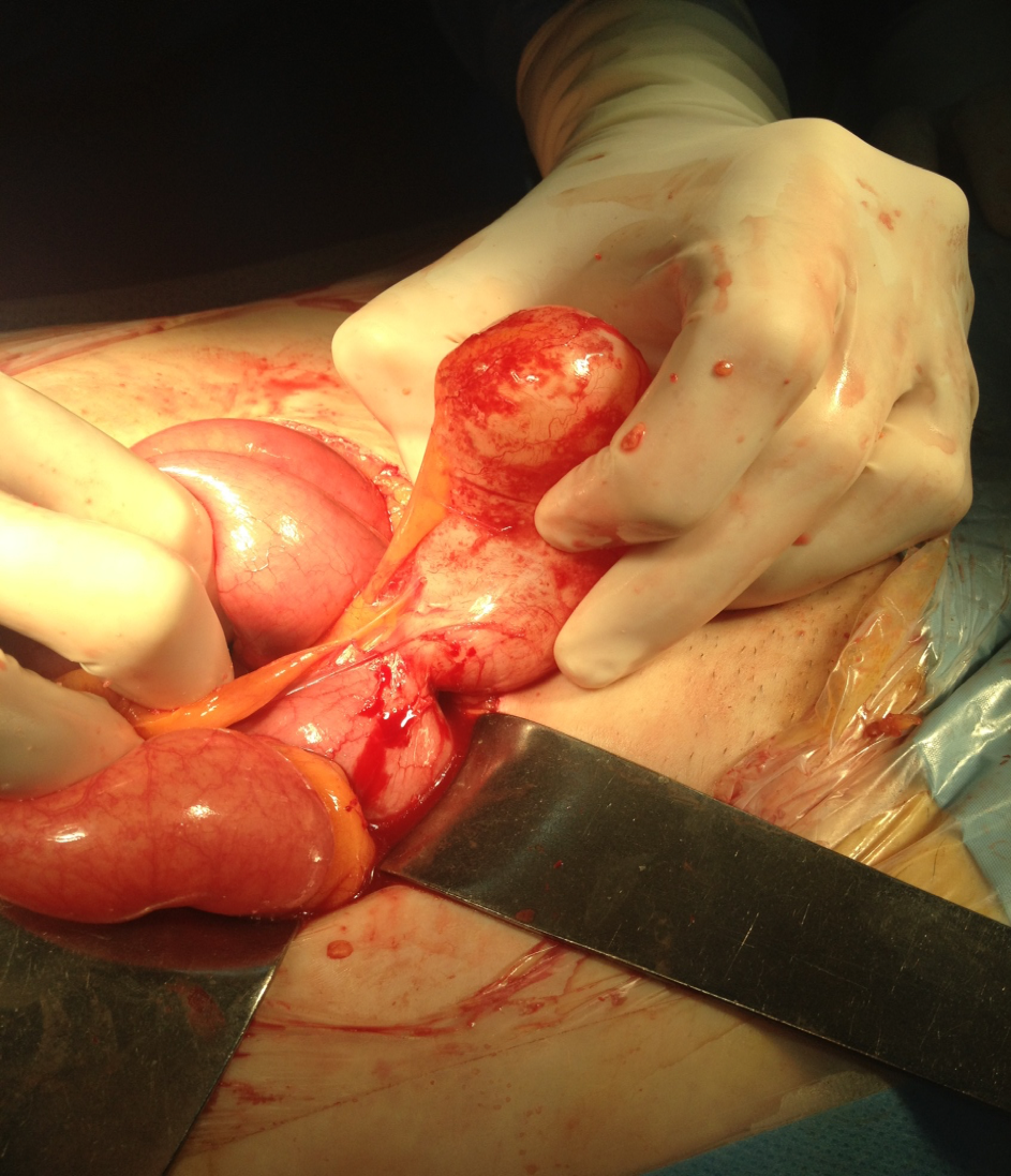 Operative image of appendiceal mucinous cystadenoma (MCA).
