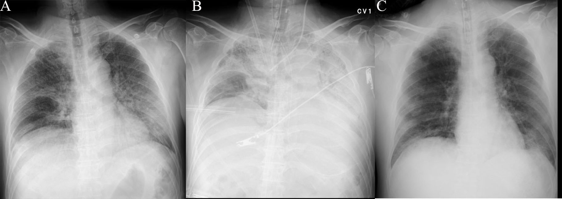 Chest X-ray of a 56-year-old man with COVID-19.(A) On arrival at ER. Ground-glass opacities are apparent in both lobes.(B) After VV-ECMO cannulation in ER. Bilateral pulmonary infiltrates
have progressed.(C) Day 6; after removal of VV-ECMO. Bilateral pulmonary infiltrates
have improved.
VV-ECMO: veno-venous extracorporeal membrane oxygenation.