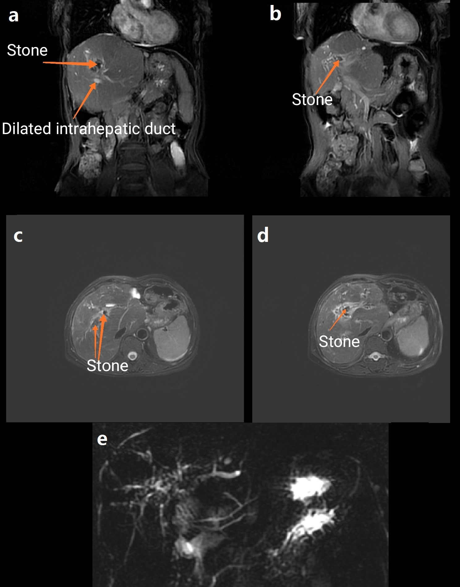 (a-e) MRCP showed that plenty of stones blocking in the
intrahepatic duct. (arrow)