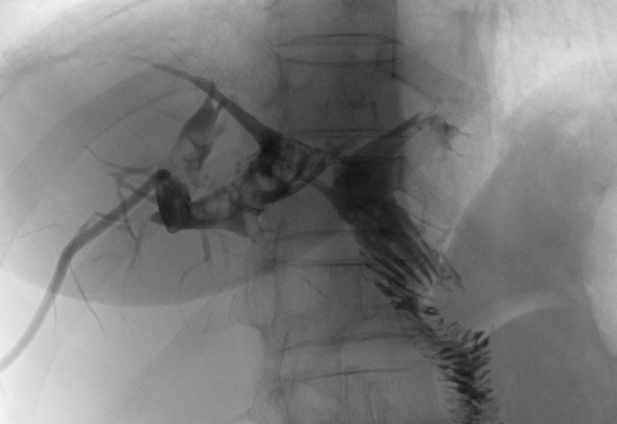 Percutaneous transhepatic cholangiography showed full filling
defect in intrahepatic duct.