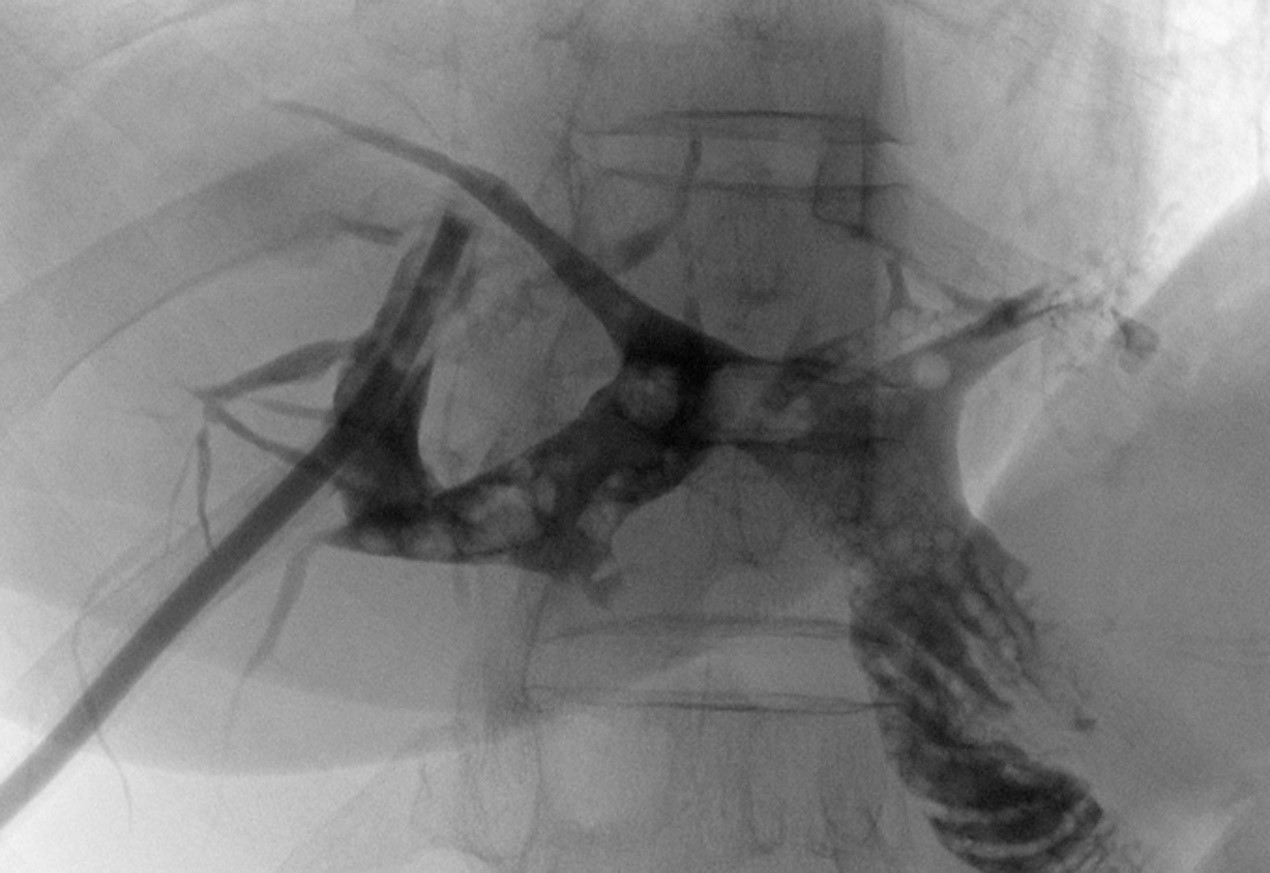 Cholangiography after PTCLS, indicating many residual stones in
the right biliary duct.