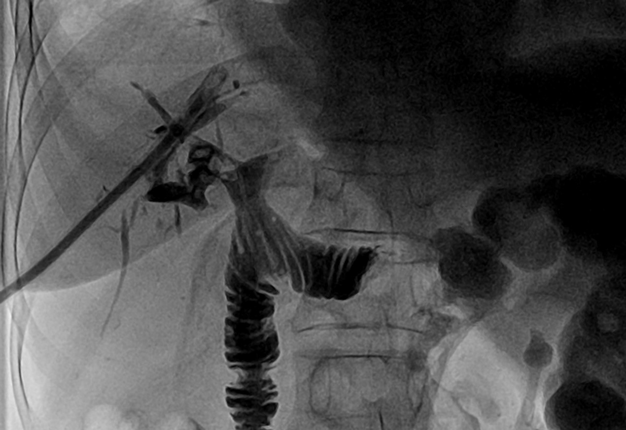 Cholangiography before the third course showed that a huge stone
has impacted in the right biliary ducts.