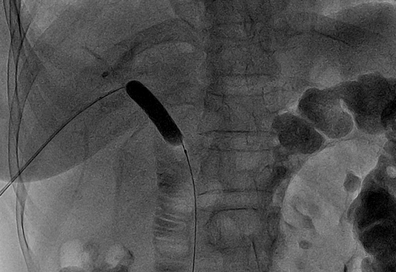 The hepaticojejunostomy was dilated by Dilation Balloon.
