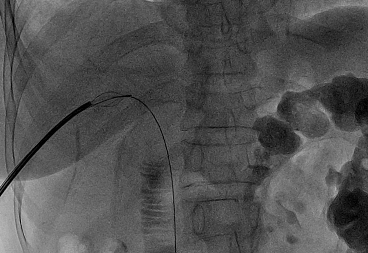 The huge biliary stone was crushed by Mechanical Lithotripter.