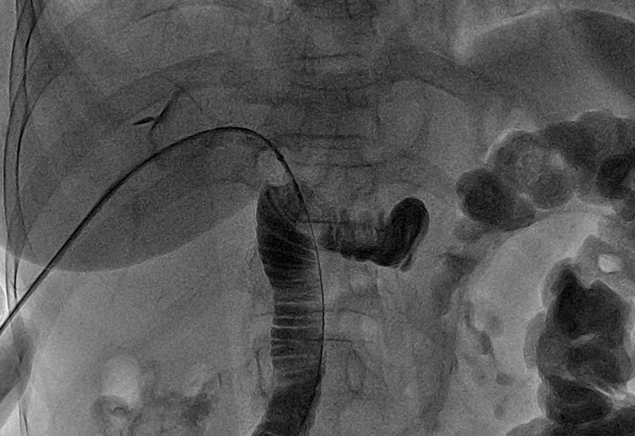 The stones were pushed into the intestine with Fogarty balloon
catheter.