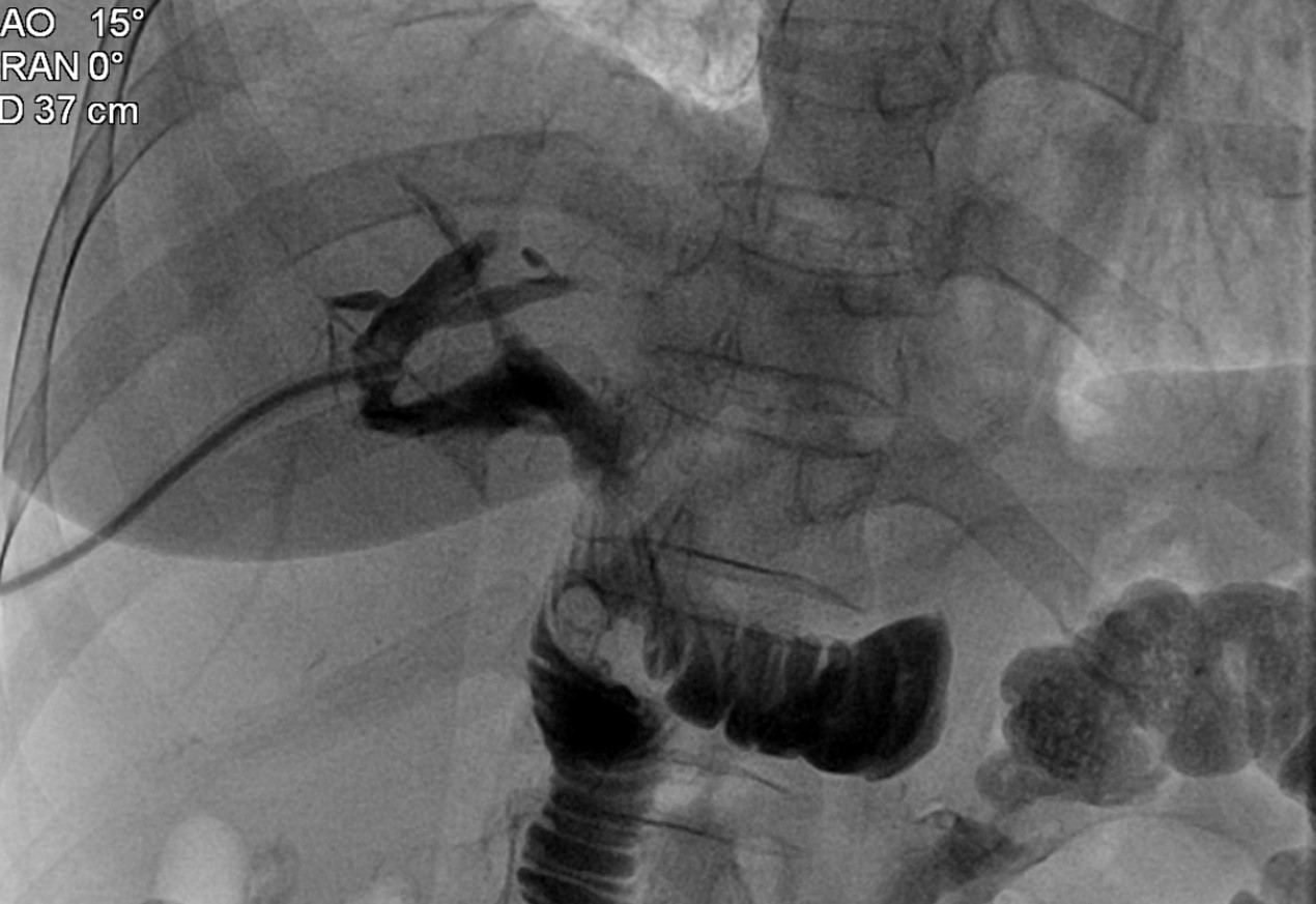 Cholangiography shows complete clearance of stone after the
interventional procedure and the stones was pushed into the intestine.