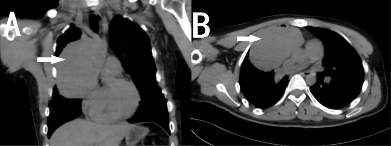 Plain CT images of coronal (A), axial (B) showing a prominent right upper ediastinal bulge (arrows).