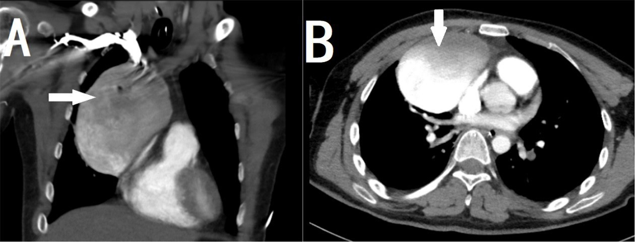 Contrast-enhanced CT (thorax) of coronal (A) and axial (B) section showing SVC aneurysm.