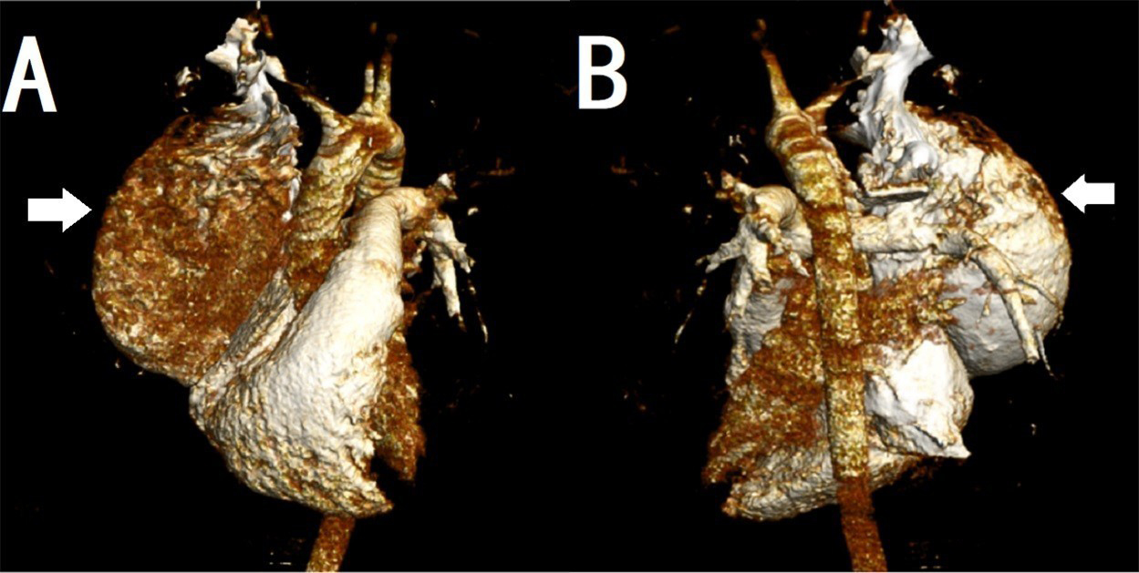 3D reconstructed image of CT (thorax) in angiographic protocol
demonstrating SVC aneurysm.
